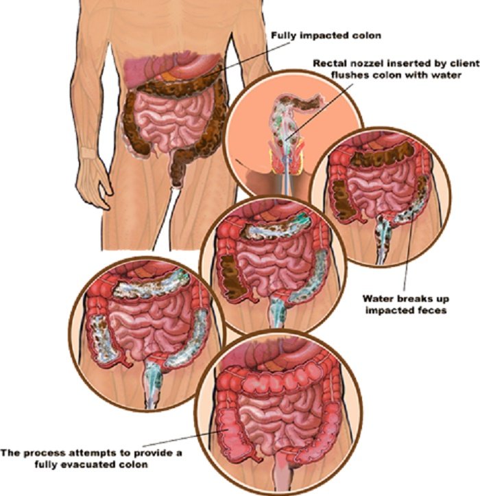 Colon Cleanse Machine 179